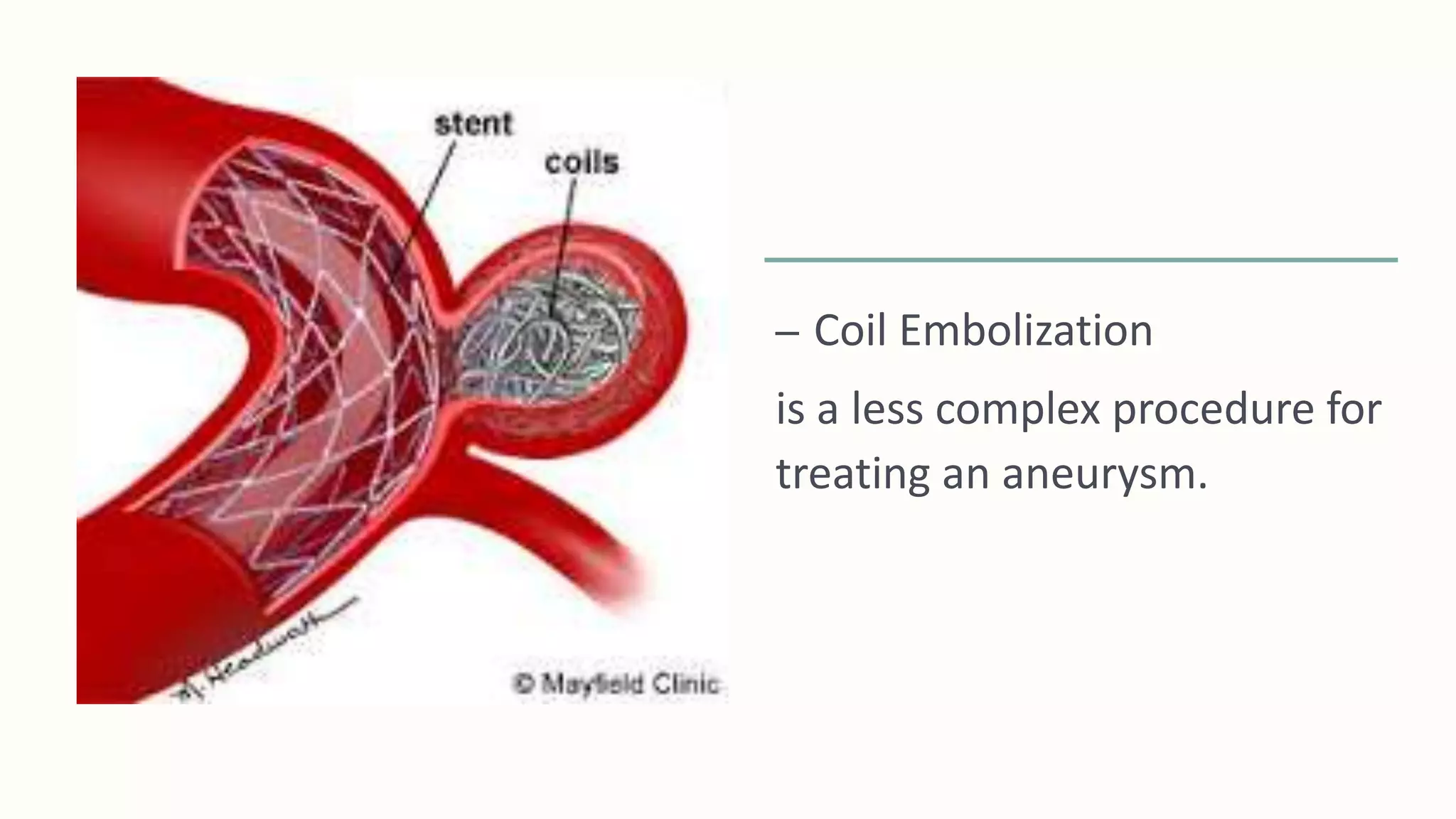 – Coil Embolization
is a less complex procedure for
treating an aneurysm.
 