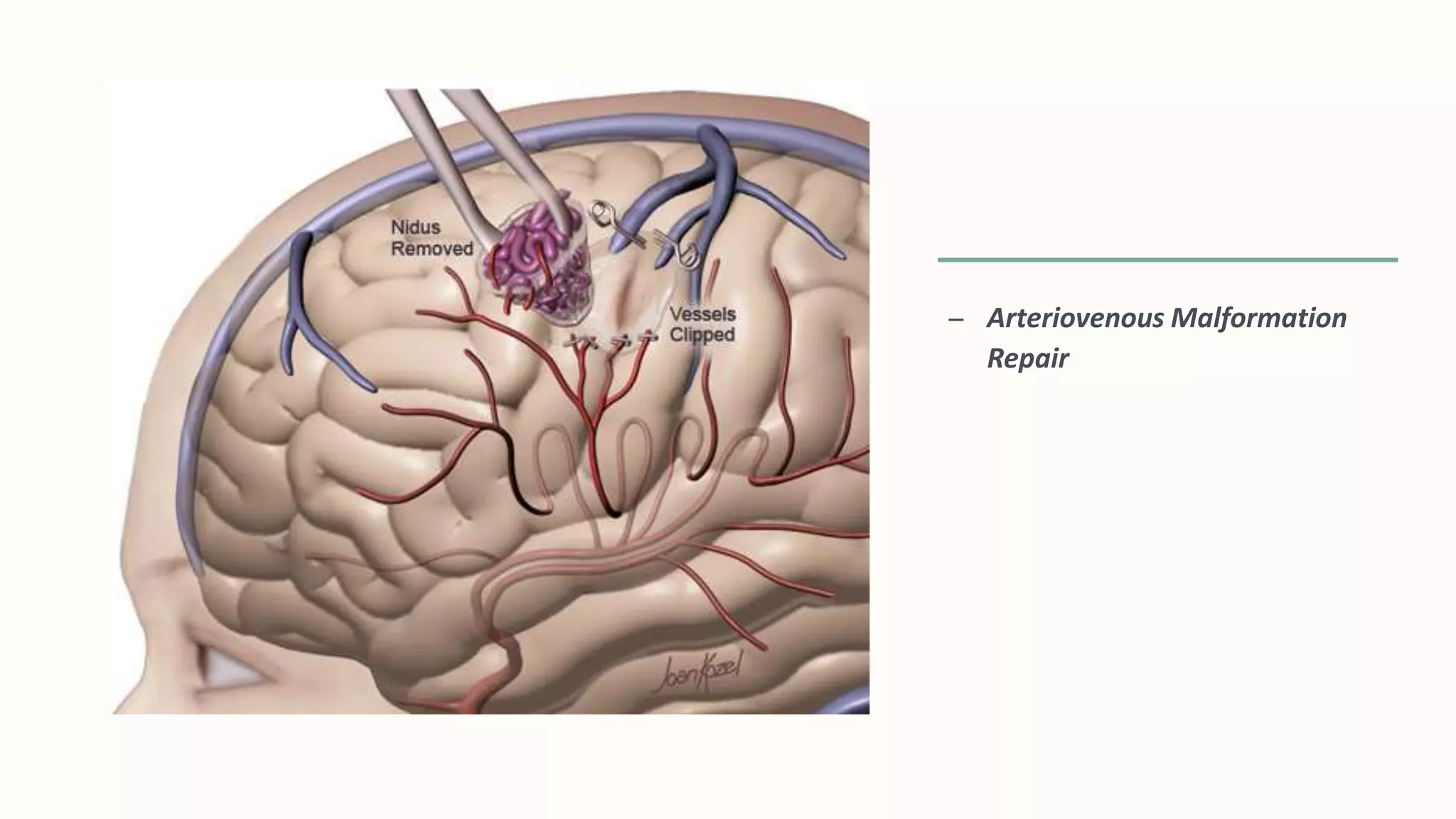 – Arteriovenous Malformation
Repair
 