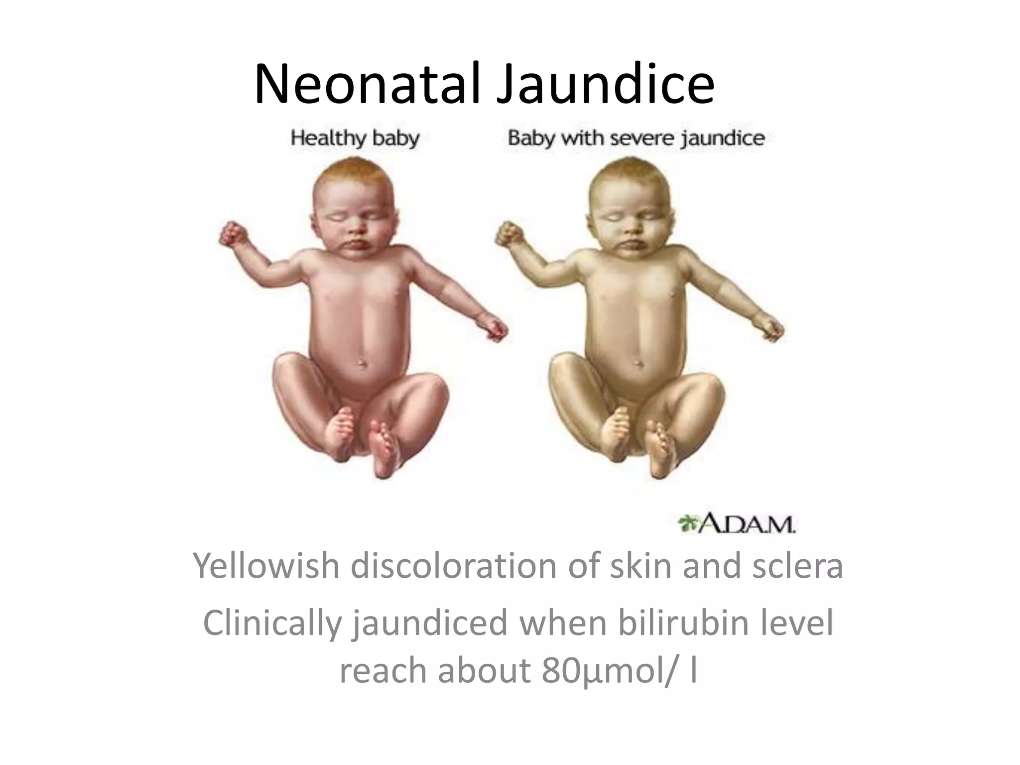 Neonatal Jaundice
Yellowish discoloration of skin and sclera
Clinically jaundiced when bilirubin level
reach about 80µmol/ l
 