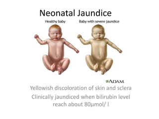 Neonatal Jaundice
Yellowish discoloration of skin and sclera
Clinically jaundiced when bilirubin level
reach about 80µmol/ l
 