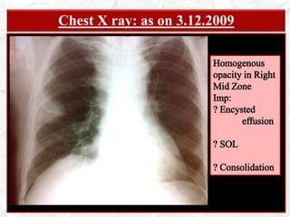 Malaise, muscle pain, headcahe