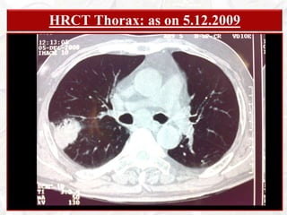 Mild hoarseness of voice for last 14days