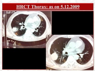 Hospitalisation for these complains 15 days back from where he was refferredHistory of Present Illness: Negative HistoryThere was no history of
