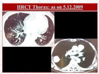 Fever, recurring drenching night sweats