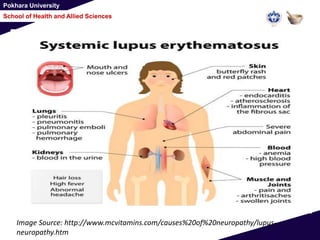 Pokhara University
School of Health and Allied Sciences
Image Source: http://www.mcvitamins.com/causes%20of%20neuropathy/lupus-
neuropathy.htm
 