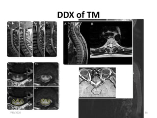 DDX of TM
7/30/2020 16
 