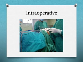 Intraoperative
 