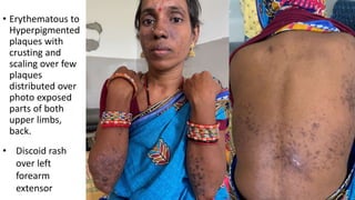 Case Presentation Systemic lupus erythematosus ).pptx