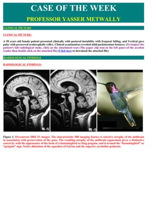 CLINICAL PICTURE:
A 50 years old female patient presented clinically with postural instability with frequent falling, and Vertical gave
palsy with preserved oculocephalic reflex. Clinical examination revealed mild parkinsonian features. (To inspect the
patient's full radiological study, click on the attachment icon (The paper clip icon in the left pane) of the acrobat
reader then double click on the attached file) (Click here to download the attached file)
RADIOLOGICAL FINDINGS:
Figure 1. Precontrast MRI T1 images. The characteristic MR imaging feature is selective atrophy of the midbrain
in association with preservation of the pons. The resulting atrophy of the midbrain tegmentum gives a distinctive
concavity with the appearance of the beak of a hummingbird or king penguin, and is termed the “hummingbird” or
“penguin” sign. Notice dilatation of the aqueduct of Sylvius and the superior cerebellar peduncle.
CASE OF THE WEEK
PROFESSOR YASSER METWALLY
CLINICAL PICTURE
RADIOLOGICAL FINDINGS
 