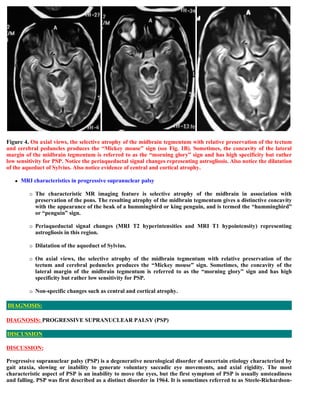 Figure 4. On axial views, the selective atrophy of the midbrain tegmentum with relative preservation of the tectum
and cerebral peduncles produces the “Mickey mouse” sign (see Fig. 1B). Sometimes, the concavity of the lateral
margin of the midbrain tegmentum is referred to as the “morning glory” sign and has high specificity but rather
low sensitivity for PSP. Notice the periaqueductal signal changes representing astrogliosis. Also notice the dilatation
of the aqueduct of Sylvius. Also notice evidence of central and cortical atrophy.
 MRI characteristics in progressive supranuclear palsy
 The characteristic MR imaging feature is selective atrophy of the midbrain in association with
preservation of the pons. The resulting atrophy of the midbrain tegmentum gives a distinctive concavity
with the appearance of the beak of a hummingbird or king penguin, and is termed the “hummingbird”
or “penguin” sign.
 Periaqueductal signal changes (MRI T2 hyperintensities and MRI T1 hypointensity) representing
astrogliosis in this region.
 Dilatation of the aqueduct of Sylvius.
 On axial views, the selective atrophy of the midbrain tegmentum with relative preservation of the
tectum and cerebral peduncles produces the “Mickey mouse” sign. Sometimes, the concavity of the
lateral margin of the midbrain tegmentum is referred to as the “morning glory” sign and has high
specificity but rather low sensitivity for PSP.
 Non-specific changes such as central and cortical atrophy.
DIAGNOSIS: PROGRESSIVE SUPRANUCLEAR PALSY (PSP)
DISCUSSION:
Progressive supranuclear palsy (PSP) is a degenerative neurological disorder of uncertain etiology characterized by
gait ataxia, slowing or inability to generate voluntary saccadic eye movements, and axial rigidity. The most
characteristic aspect of PSP is an inability to move the eyes, but the first symptom of PSP is usually unsteadiness
and falling. PSP was first described as a distinct disorder in 1964. It is sometimes referred to as Steele-Richardson-
DIAGNOSIS:
DISCUSSION
 