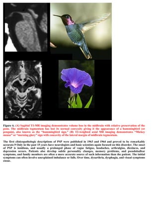 Figure 6. (A) Sagittal T1-MR imaging demonstrates volume loss in the midbrain with relative preservation of the
pons. The midbrain tegmentum has lost its normal convexity giving it the appearance of a hummingbird (or
penguin), also known as the “hummingbird sign.” (B) T2-weighted axial MR imaging demonstrates “Mickey
mouse” or “morning glory” sign with concavity of the lateral margin of midbrain tegmentum.
The first clinicopathologic descriptions of PSP were published in 1963 and 1964 and proved to be remarkably
accurate.9 Only in the past 15 years have neurologists and basic scientists again focused on this disorder. The onset
of PSP is insidious, and usually a prolonged phase of vague fatigue, headaches, arthralgias, dizziness, and
depression occurs. Patients also develop subtle personality changes, memory problems, and pseudobulbar
symptoms, and family members are often a more accurate source of such information than the patient. The initial
symptoms can often involve unexplained imbalance or falls. Over time, dysarthria, dysphagia, and visual symptoms
ensue.
 