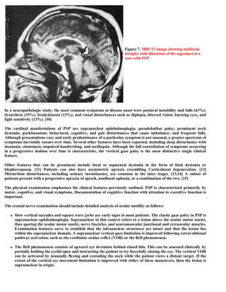 In a neuropathologic study, the most common symptoms at disease onset were postural instability and falls (63%);
dysarthria (35%); bradykinesia (13%); and visual disturbances such as diplopia, blurred vision, burning eyes, and
light sensitivity (13%). [10]
The cardinal manifestations of PSP are supranuclear ophthalmoplegia; pseudobulbar palsy; prominent neck
dystonia; parkinsonism; behavioral, cognitive, and gait disturbances that cause imbalance; and frequent falls.
Although presentations vary and early predominance of a particular symptom is not unusual, a greater spectrum of
symptoms inevitably ensues over time. Several other features have been reported, including sleep disturbance with
insomnia, clumsiness, impaired handwriting, and oscillopsia. Although the full constellation of symptoms occurring
in a progressive fashion over time is characteristic, the vertical gaze palsy is the most distinctive single clinical
feature.
Other features that can be prominent include focal or segmental dystonia in the form of limb dystonia or
blepharospasm. [11] Patients can also have asymmetric apraxia resembling Corticobasal degeneration. [12]
Micturition disturbances, including urinary incontinence, are common in the later stages. [13,14] A subset of
patients present with a progressive apraxia of speech, nonfluent aphasia, or a combination of the two. [15]
The physical examination emphasizes the clinical features previously outlined. PSP is characterized primarily by
motor, cognitive, and visual symptoms. Documentation of cognitive function with attention to executive function is
important.
The cranial nerve examination should include detailed analysis of ocular motility as follows:
 Slow vertical saccades and square wave jerks are early signs in most patients. The classic gaze palsy in PSP is
supranuclear ophthalmoplegia. Supranuclear in this context refers to a lesion above the ocular motor nuclei,
thus sparing the ocular motor nuclei, nerve fascicles, and neuromuscular junctional and extraocular muscles.
Examination features serve to establish that the infranuclear structures are intact and that the lesion lies
within the supranuclear domain. A supranuclear vertical gaze limitation is improved following extravolitional
pathway activation, such as the vestibular ocular reflex (VOR) or the Bell phenomenon.
 The Bell phenomenon consists of upward eye deviation behind closed lids. This can be assessed clinically by
partially holding the eyelid open and instructing the patient to try forcefully closing the eye. The vertical VOR
can be activated by manually flexing and extending the neck while the patient views a distant target. If the
extent of the vertical eye movement limitation is improved with either of these maneuvers, then the lesion is
supranuclear in origin.
Figure 7. MRI T1 image showing midbrain
atrophy with dilatation of the aqueduct in a
case with PSP
 