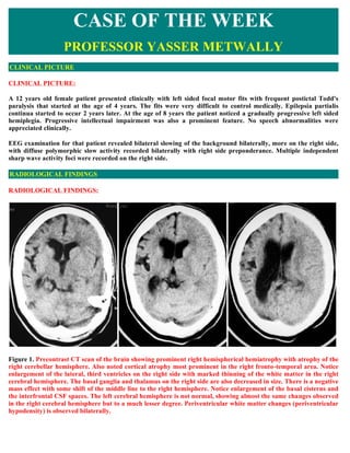 CASE OF THE WEEK
                   PROFESSOR YASSER METWALLY
CLINICAL PICTURE

CLINICAL PICTURE:

A 12 years old female patient presented clinically with left sided focal motor fits with frequent postictal Todd's
paralysis that started at the age of 4 years. The fits were very difficult to control medically. Epilepsia partialis
continua started to occur 2 years later. At the age of 8 years the patient noticed a gradually progressive left sided
hemiplegia. Progressive intellectual impairment was also a prominent feature. No speech abnormalities were
appreciated clinically.

EEG examination for that patient revealed bilateral slowing of the background bilaterally, more on the right side,
with diffuse polymorphic slow activity recorded bilaterally with right side preponderance. Multiple independent
sharp wave activity foci were recorded on the right side.

RADIOLOGICAL FINDINGS

RADIOLOGICAL FINDINGS:




Figure 1. Precontrast CT scan of the brain showing prominent right hemispherical hemiatrophy with atrophy of the
right cerebellar hemisphere. Also noted cortical atrophy most prominent in the right fronto-temporal area. Notice
enlargement of the lateral, third ventricles on the right side with marked thinning of the white matter in the right
cerebral hemisphere. The basal ganglia and thalamus on the right side are also decreased in size. There is a negative
mass effect with some shift of the middle line to the right hemisphere. Notice enlargement of the basal cisterns and
the interfrontal CSF spaces. The left cerebral hemisphere is not normal, showing almost the same changes observed
in the right cerebral hemisphere but to a much lesser degree. Periventricular white matter changes (periventricular
hypodensity) is observed bilaterally.
 