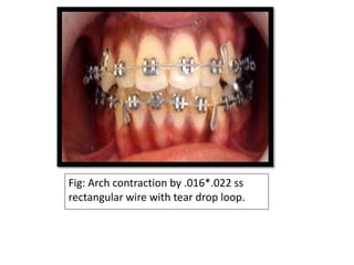 Fig: Arch contraction by .016*.022 ss
rectangular wire with tear drop loop.
 