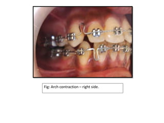 Fig: Arch contraction – right side.
 
