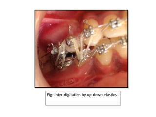 Fig: Inter-digitation by up-down elastics.
 