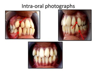 Intra-oral photographs
 