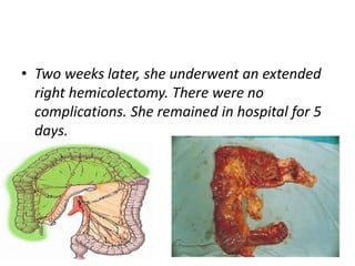 • Two weeks later, she underwent an extended
right hemicolectomy. There were no
complications. She remained in hospital for 5
days.
 