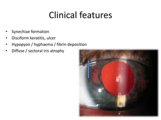 case report.This is a 60 years old female patient, a known Glaucoma ...