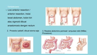 CASE REPORT - CARCINOMA RECTAL tumor.pptx