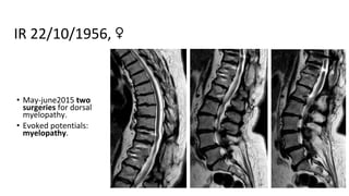 • May-june2015 two
surgeries for dorsal
myelopathy.
• Evoked potentials:
myelopathy.
IR 22/10/1956, ♀
 