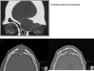 Frontāla dobuma mukocēle
 