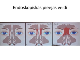 Endoskopiskās pieejas veidi
 
