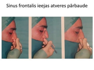 Sinus frontalis ieejas atveres pārbaude
 