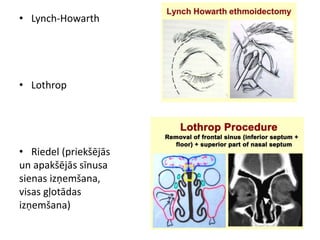 • Lynch-Howarth
• Lothrop
• Riedel (priekšējās
un apakšējās sīnusa
sienas izņemšana,
visas gļotādas
izņemšana)
 