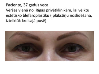 Paciente, 37 gadus veca
Vēršas vienā no Rīgas privātklīnikām, lai veiktu
estētisko blefaroplastiku ( plākstiņu noslīdēšana,
izteiktāk kreisajā pusē)
 