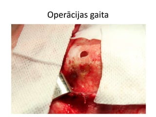 Operācijas gaita
 