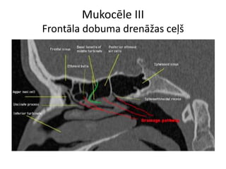 Mukocēle III
Frontāla dobuma drenāžas ceļš
 
