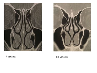 A variants B 1 variants
 