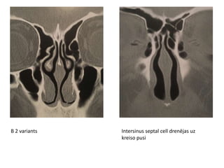 B 2 variants Intersinus septal cell drenējas uz
kreiso pusi
 