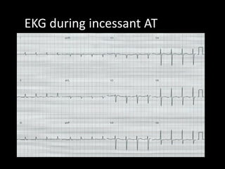 EKG during incessant AT
 