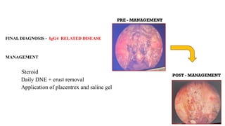 case report presentation , igG4 inflammatory disease | PPTX