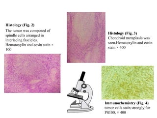 Histology (Fig. 3)
Chondroid metaplasia was
seen.Hematoxylin and eosin
stain × 400
Histology (Fig. 2)
The tumor was composed of
spindle cells arranged in
interlacing fascicles.
Hematoxylin and eosin stain ×
100
Immunochemistry (Fig. 4)
tumor cells stain strongly for
PS100, × 400
 