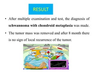 RESULT
• After multiple examination and test, the diagnosis of
schwannoma with chondroid metaplasia was made.
• The tumor mass was removed and after 8 month there
is no sign of local recurrence of the tumor.
 