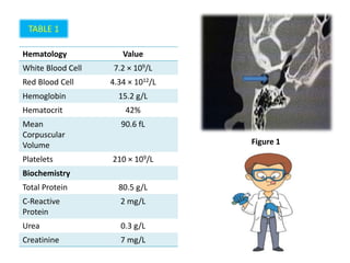 TABLE 1
Hematology Value
White Blood Cell 7.2 × 109/L
Red Blood Cell 4.34 × 1012/L
Hemoglobin 15.2 g/L
Hematocrit 42%
Mean
Corpuscular
Volume
90.6 fL
Platelets 210 × 109/L
Biochemistry
Total Protein 80.5 g/L
C-Reactive
Protein
2 mg/L
Urea 0.3 g/L
Creatinine 7 mg/L
Figure 1
 