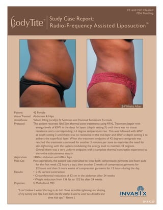 CE and ISO Cleared
                                                                                                        FDA Pending

                                  Study Case Report:
                                  Radio-Frequency Assisted Liposuction ™




                                                                                              24 Weeks After
Patient:          42 Female
Areas Treated:    Abdomen & Hips
Anesthesia:       Valium 10mg (orally), IV Sedation and Hunstad Tumescent Formula
Protocol:         The patient received 10x15cm thermal zone treatments using RFAL. Treatment began with
                     energy levels of 65W in the deep fat layers (depth setting 5) until there was no tissue
                     resistance and a corresponding 3-5 degree temperature rise. This was followed with 60W
                     at depth setting 3 until there was no resistance in the mid-layer and 60W at depth setting 2 to
                     address the superﬁcial layer. When the treatment endpoint of 42 degrees centigrade was
                     reached the treatment continued for another 3 minutes per zone to maximize the need for
                     skin tightening, with the system modulating the energy level to maintain 42 degrees.
                     Overall there was a very uniform endpoint with a complete thermal contractile experience to
                     the entire subcutaneous matrix.
Aspiration:       1800cc abdomen and 600cc hips
Post-Op:          Post-operatively, the patient was instructed to wear both compression garments and foam pads
                     for the ﬁrst week (22 hours a day), then another 2 weeks of compression garments for
                     22 hours and then 3 more weeks of compression garments for 12 hours during the day.
Results:          • 21% vertical contraction
                  • Circumferential reduction of 12 cm in the abdomen after 24 weeks
                  • Weight reduction from 136 lbs to 132 lbs after 24 weeks
Physician:        S. Mulholland, MD

   “I can’t believe I waited this long to do this! I have incredible tightening and shaping
   of my tummy and hips. I am back into the clothes I used to wear two decades and
                                   three kids ago.” - Patient L
                                                                                                                SM.9.42.LF
 