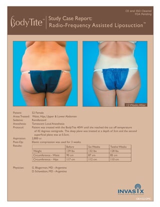 CE and ISO Cleared
                                                                                                    FDA Pending
                              Study Case Report:
                              Radio-Frequency Assisted Liposuction ™




                                                                                               12 Weeks After

Patient:         52 Female
Areas Treated:   Waist, Hips, Upper & Lower Abdomen
Sedative:        Remifentanil
Anesthesia:      Tumescent Local Anesthesia
Protocol:        Patient was treated with the BodyTite 40W until she reached the cut off temperature
                   of 42 degrees centigrade. The deep plane was treated at a depth of 3cm and the second
                   superﬁcial plane was at 0.5cm.
Aspiration:      2,800 cc
Post-Op:         Elastic compression was used for 3 weeks.
Results:                                     Before            Six Weeks         Twelve Weeks
                  Weight                     139 lbs           132 lbs           128 lbs
                  Circumference - Waist      90 cm             87 cm             85 cm
                  Circumference - Hips       117 cm            112 cm            110 cm

Physician:       G. Blugerman, MD - Argentina
                 D. Schavelzon, MD - Argentina




                                                                                                       GB.4.52.GMC
 