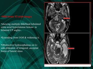 •MRI brain T2 axial images
•showing multiple illdefined lobulated
extra axial hyperintense lesions in
bilateral CP angles .
•Extending from IAM & widening it.
•Obstructive hydrocephalous on Lt
side,dilatation of temporal ,occipital
horns of lateral sinus
 