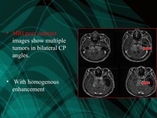 • MRI post contrast
images show multiple
tumors in bilateral CP
angles.
• With homogenous
enhancement
 