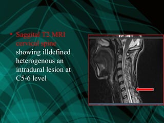 • Saggital T2 MRI
cervical spine
showing illdefined
heterogenous an
intradural lesion at
C5-6 level
 