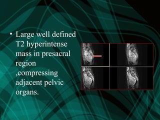 • Large well defined
T2 hyperintense
mass in presacral
region
,compressing
adjacent pelvic
organs.
 