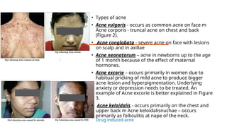• Types of acne
• Acne vulgaris - occurs as common acne on face m
Acne corporis - truncal acne on chest and back
(Figure 2).
• Acne conglobata - severe acne on face with lesions
on scalp and in axillae
• Acne neonatarum – acne in newborns up to the age
of 1 month because of the effect of maternal
hormones.
• Acne excorie – occurs primarily in women due to
habitual pricking of mild acne to produce bigger
acne lesion and hyperpigmentation. Underlying
anxiety or depression needs to be treated. An
example of Acne excorie is better explained in Figure
3.
• Acne keloidalis - occurs primarily on the chest and
upper back m Acne keloidalisnuchae – occurs
primarily as folliculitis at nape of the neck.
Drug induced acne
 