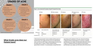 What Grade acne does our
Patient have?
 