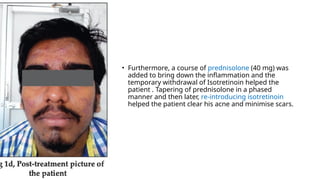 • Furthermore, a course of prednisolone (40 mg) was
added to bring down the inflammation and the
temporary withdrawal of Isotretinoin helped the
patient . Tapering of prednisolone in a phased
manner and then later, re-introducing isotretinoin
helped the patient clear his acne and minimise scars.
 