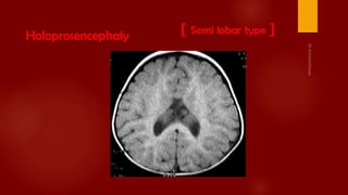 Case review ct mri brain part 2 dr ahmed esawy