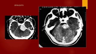 Case review ct mri brain part 2 dr ahmed esawy